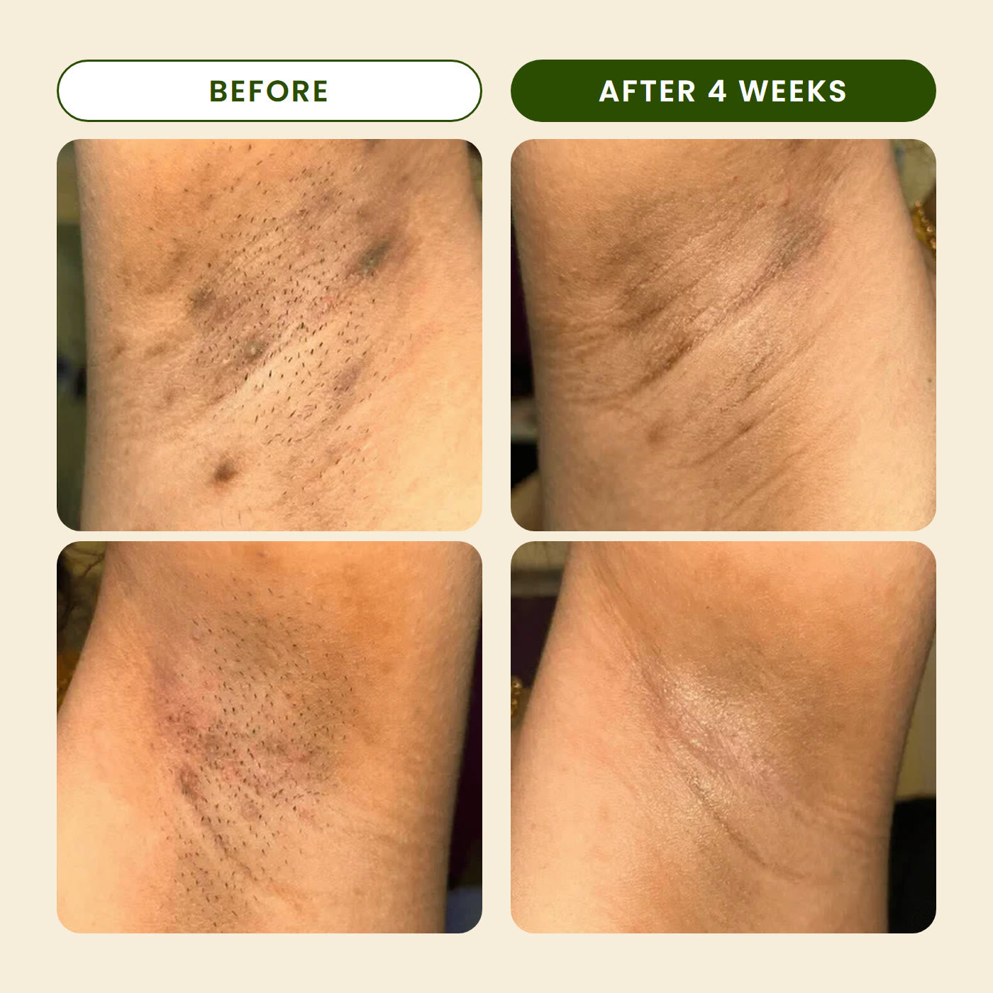 Before and after 4 weeks: darker underarms look lighter (customer results with the same turmeric formula)
