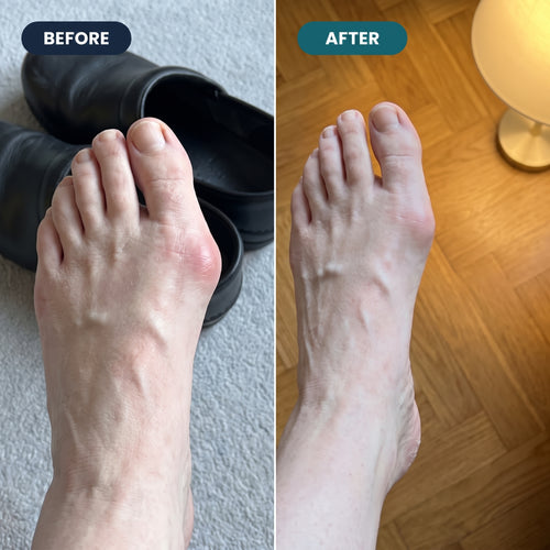 Align EMS Bunion Corrector