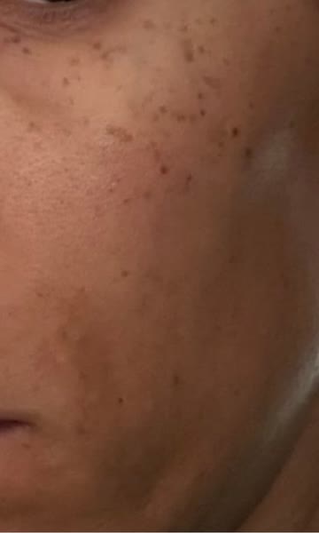 Carolyn P. – Before