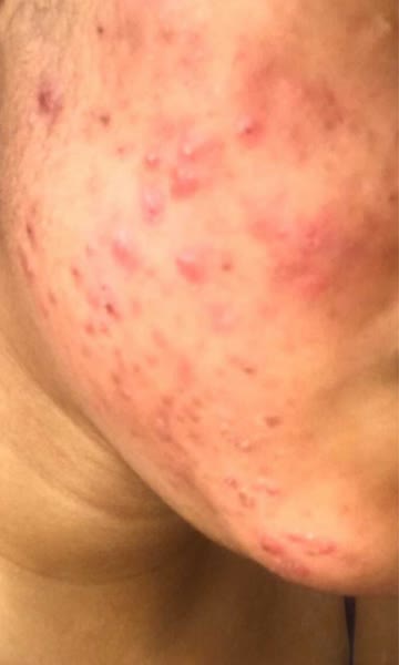 Rachel S. – Before