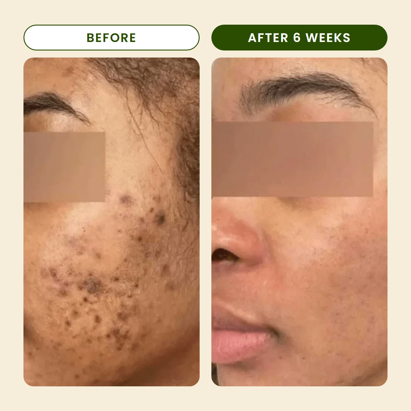 Before and after 6 weeks: dark spots on the cheek look lighter (customer results with the same turmeric formula)